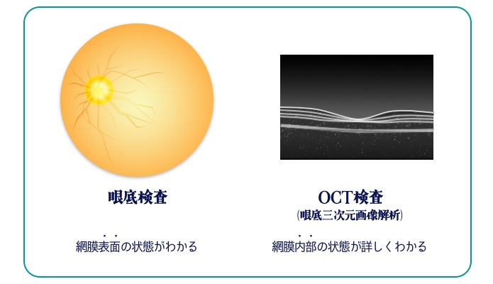 眼底検査・OCT検査のイメージ
